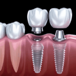 How Dental Implants Can Prevent Premature Ageing in Your Facial Structure