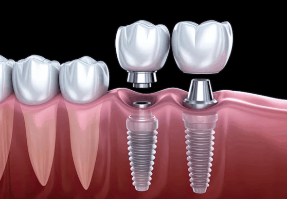 How Dental Implants Can Prevent Premature Ageing in Your Facial Structure