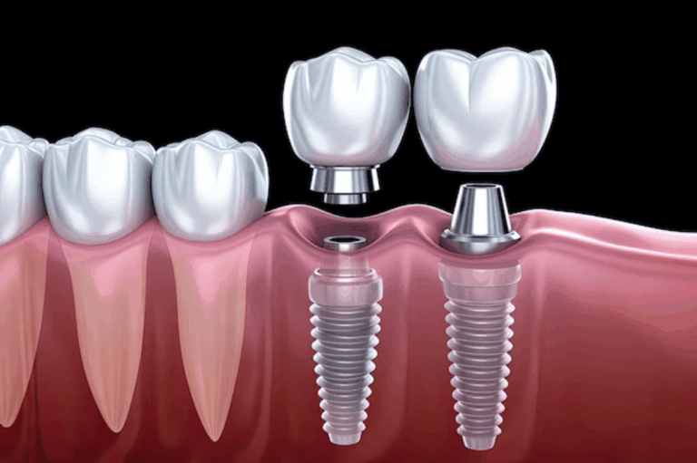 How Dental Implants Can Prevent Premature Ageing in Your Facial Structure